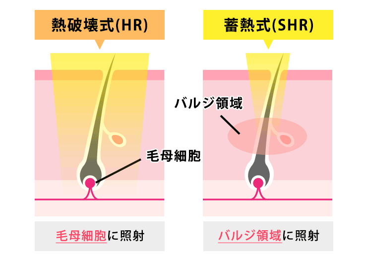 医療脱毛の照射方式の違い(熱破壊式と蓄熱式の比較)